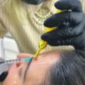 Cuidados no uso do botox evitam perda de dinheiro e problemas de saúde imagem