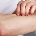Fungo de pele pode combater superbactéria extremamente perigosa imagem