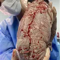 Inusitado: bebê nasce com DIU colado no corpo e caso viraliza imagem