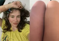 Atriz de 21 anos descobre trombose na perna ao gravar vídeo imagem