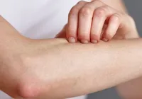 Fungo de pele pode combater superbactéria extremamente perigosa imagem