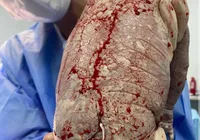 Inusitado: bebê nasce com DIU colado no corpo e caso viraliza