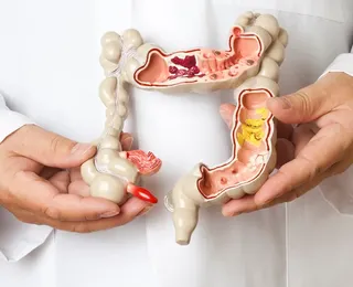 Câncer colorretal: cirurgia robótica revoluciona tratamento