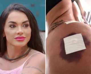 Ex de Tony Salles corrige bumbum após hidrogel: "Tá lindo"