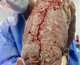 Inusitado: bebê nasce com DIU colado no corpo e caso viraliza