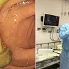 Médico encontra cogumelo crescendo no intestino de paciente em exame - Imagem