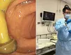Médico encontra cogumelo crescendo no intestino de paciente em exame - Imagem