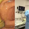 Médico encontra cogumelo crescendo no intestino de paciente em exame imagem