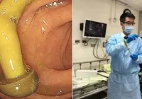 Médico encontra cogumelo crescendo no intestino de paciente em exame imagem