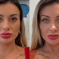 Andressa Urach sofre após cirurgia nos olhos: “Tô arrependida” imagem