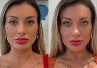 Andressa Urach sofre após cirurgia nos olhos: “Tô arrependida”