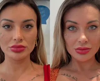 Andressa Urach sofre após cirurgia nos olhos: “Tô arrependida”