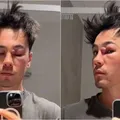 Influencer confunde cisto com espinha e fica com o rosto desfigurado imagem