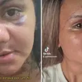 Vítima de 61 socos do ex-namorado mostra recuperação após cirurgia imagem