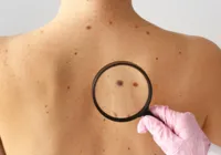 Casos de câncer aumentam em pessoas com menos de 50 anos, diz pesquisa imagem