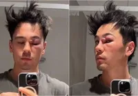Influencer confunde cisto com espinha e fica com o rosto desfigurado