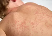 Surto de sarampo em país vizinho acende alerta para o Brasil imagem