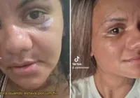 Vítima de 61 socos do ex-namorado mostra recuperação após cirurgia imagem