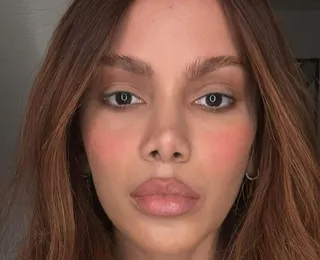 Anitta quebra o silêncio sobre novas plásticas no rosto