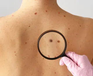 Casos de câncer aumentam em pessoas com menos de 50 anos, diz pesquisa