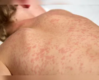 Surto de sarampo em país vizinho acende alerta para o Brasil