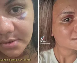 Vítima de 61 socos do ex-namorado mostra recuperação após cirurgia