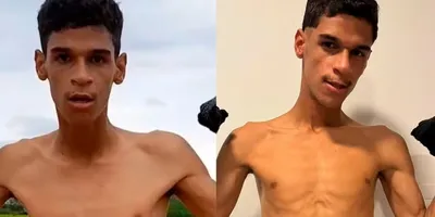 Internado, Luva de Pedreiro tem diagnóstico confirmado - Imagem