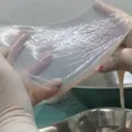 SUS aprova uso de placenta no tratamento de queimaduras imagem
