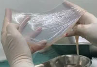SUS aprova uso de placenta no tratamento de queimaduras imagem