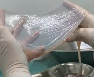 SUS aprova uso de placenta no tratamento de queimaduras