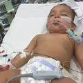 Bebê confunde soda cáustica com leite e perde metade da língua imagem