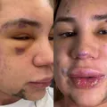 Influenciador famoso morre por complicações após procedimento estético imagem
