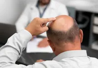 Adoçante pode ajudar a melhorar calvície de homens