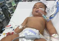 Bebê confunde soda cáustica com leite e perde metade da língua imagem