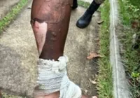 Homem é preso após atear fogo na esposa no interior da Bahia