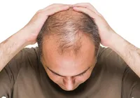 Transplante capilar: conheça mitos e verdades sobre a nova tendência