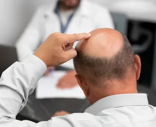 Adoçante pode ajudar a melhorar calvície de homens