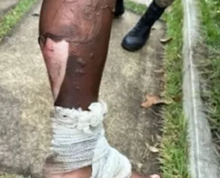 Homem é preso após atear fogo na esposa no interior da Bahia