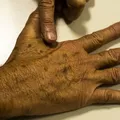 Casos de câncer em jovens adultos crescem 284% no Brasil imagem