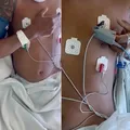 Jovem tetraplégico mexe os braços após tratamento revolucionário imagem