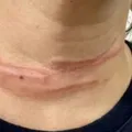 Mulher fica ferida após enroscar pescoço em fio preso a poste imagem