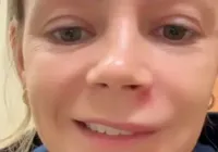 Influenciadora espreme espinha no rosto e vai parar no hospital