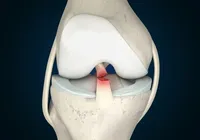 Por que o futebol feminino tem mais lesões de LCA que o masculino?