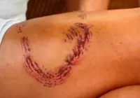 Turista revela marca de mordida de tubarão em Fernando de Noronha