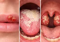 Alerta no Carnaval: Veja como o beijo pode transmitir doenças graves