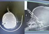 Bebê de 1 ano cai da cama e fica com carregador cravado na testa