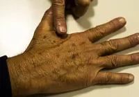 Casos de câncer em jovens adultos crescem 284% no Brasil imagem