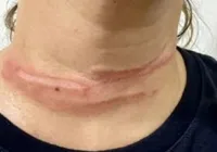 Mulher fica ferida após enroscar pescoço em fio preso a poste