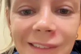 Influenciadora espreme espinha no rosto e vai parar no hospital - Imagem