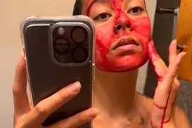 Sangue menstrual: nova tendência de skincare? Entenda os riscos - Imagem